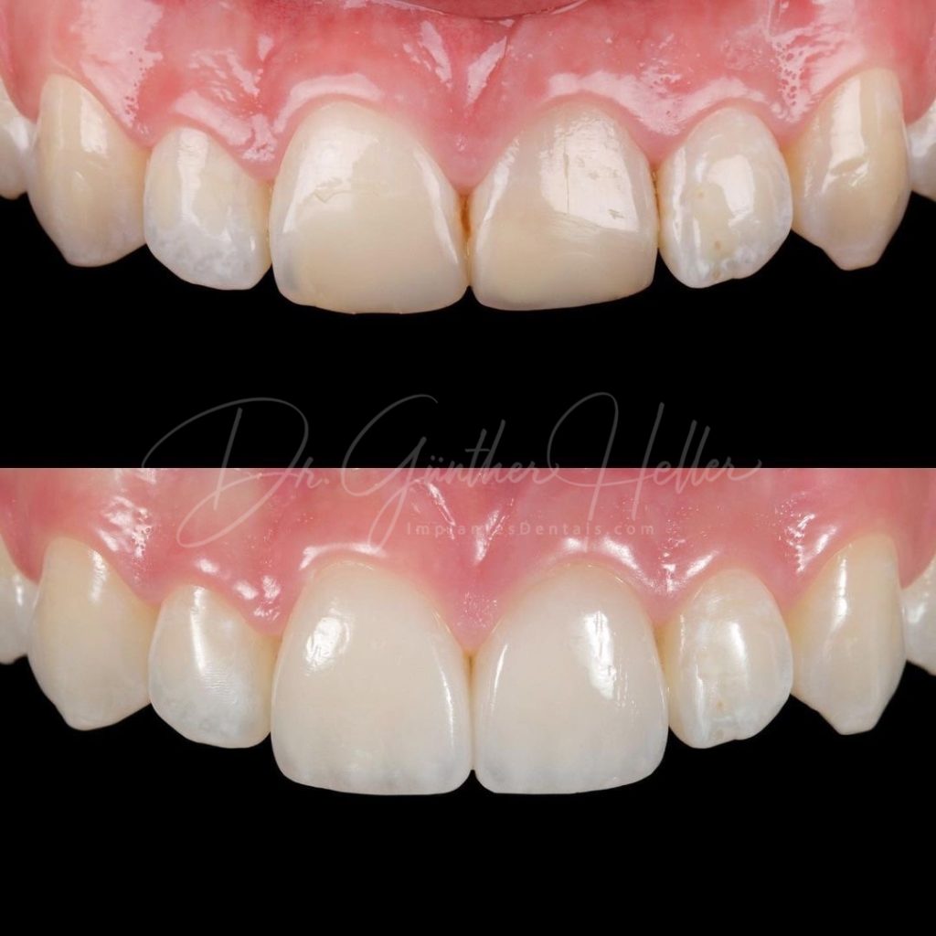 Profile Ortodontia - Antes e depois Invisalign @invisalign é um aparelho  transparente para todas as idades! Venha você também encontrar a melhor  versão do seu sorriso com Invisalign! #invisalign #invisalignbrasil  #dentista #antesedepois