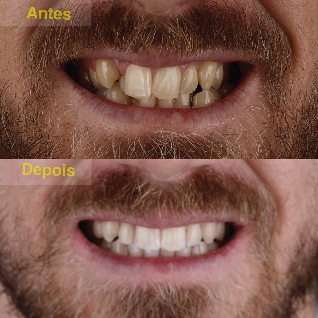 Arquivo de aparelho dental transparente - Dr Gunther